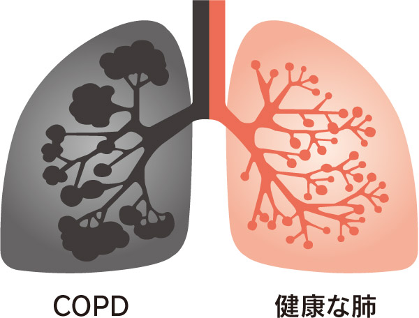 COPDと健康な肺